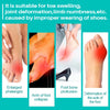 1Pcs Foot Gout Treatment Cream Thumb Corrector Finger Hallux Ointment Toe Bunion Pain Relieve Medical Plaster Health Care G019