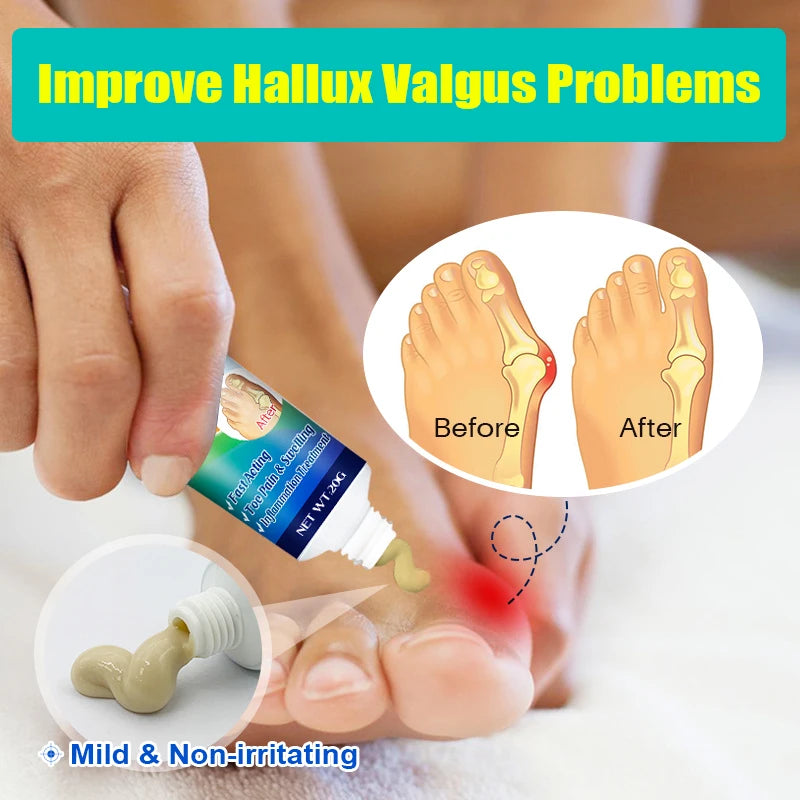 1Pcs Foot Gout Treatment Cream Thumb Corrector Finger Hallux Ointment Toe Bunion Pain Relieve Medical Plaster Health Care G019